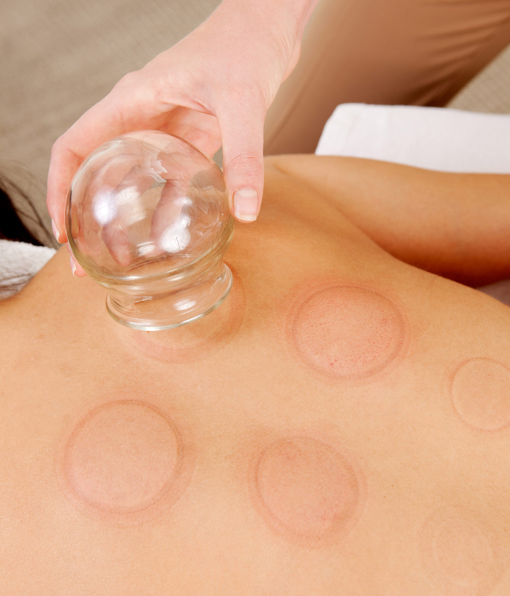Acupuncture cupping on woman's back