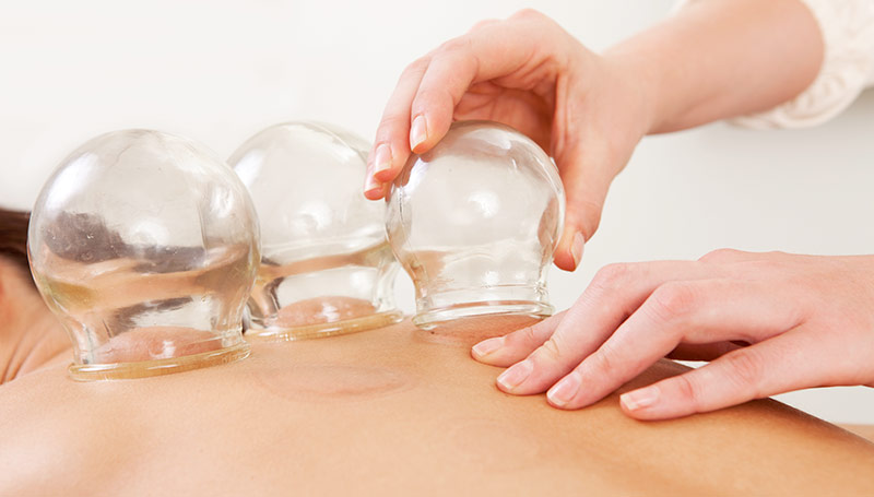 acupuncture cupping therapy
